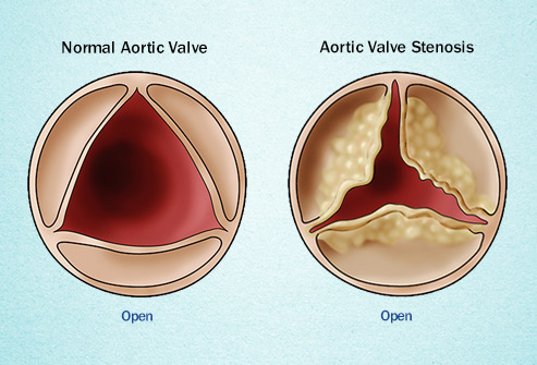 Ava Aortic Stenosis