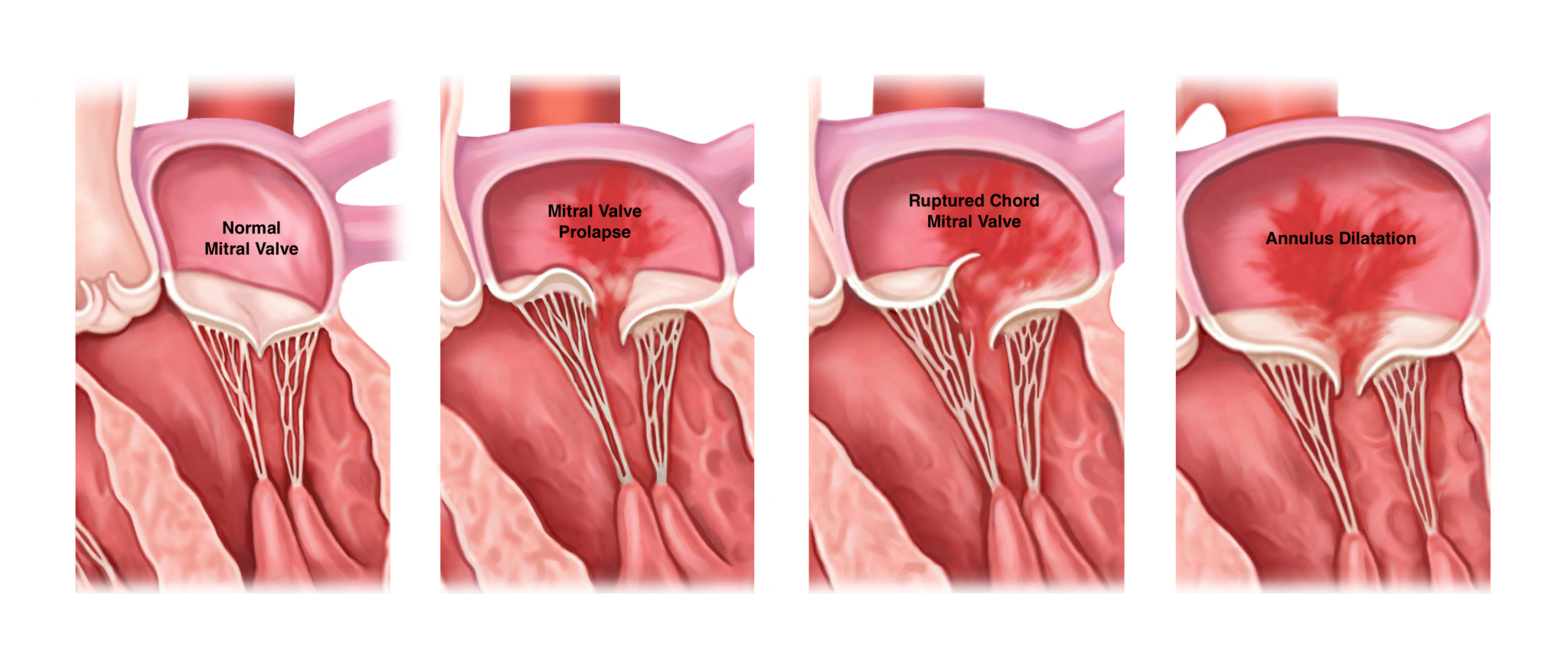 Mitral Regurgitation A Leaky Valve Gregory Koshkarian Md Facc