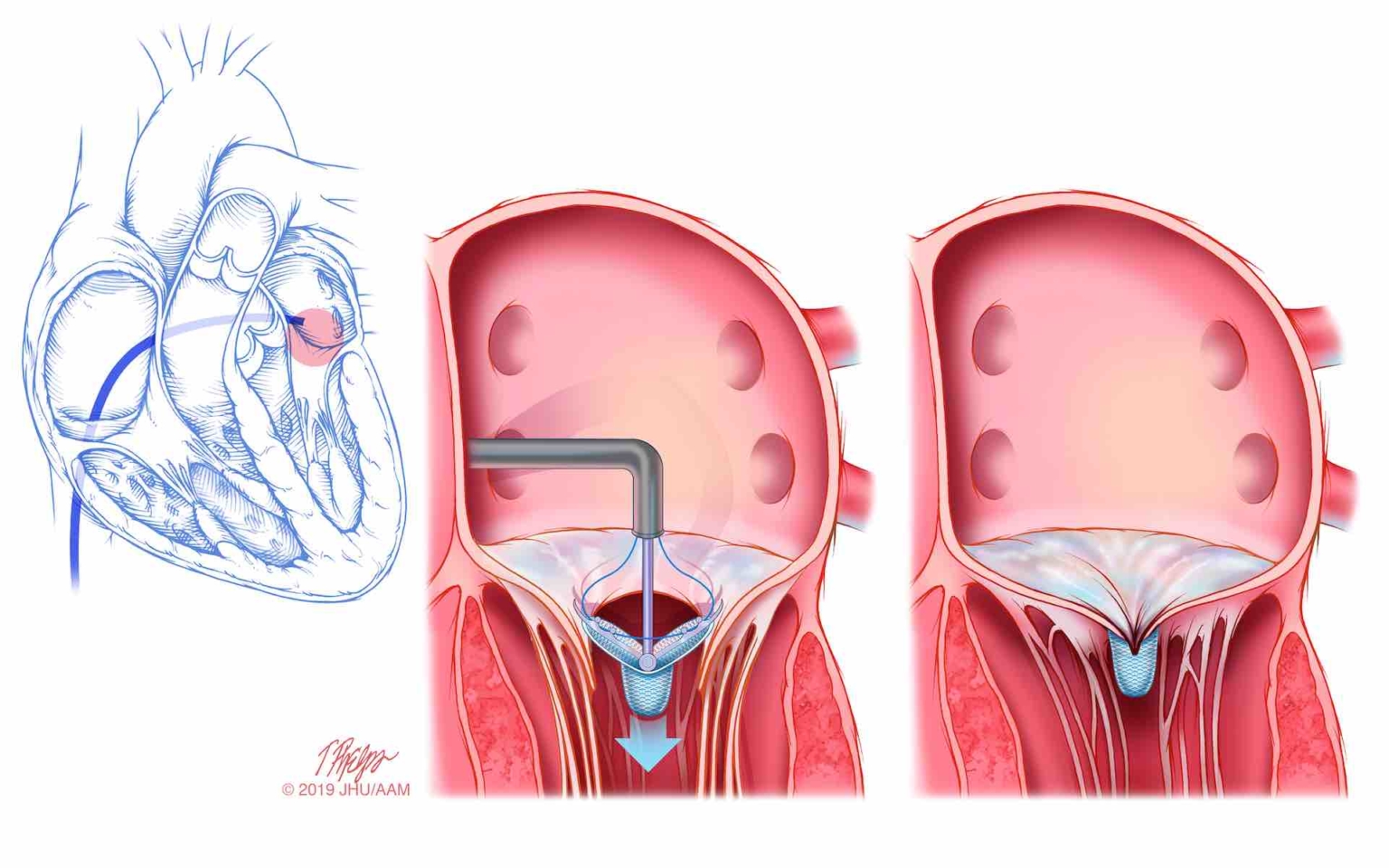 mitral-regurgitation-a-leaky-valve-gregory-koshkarian-md-facc