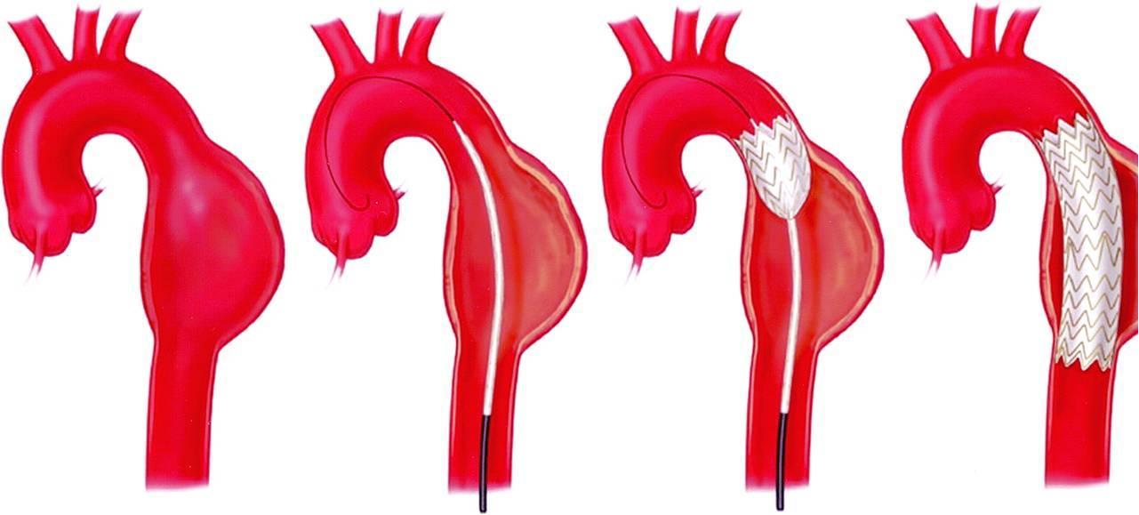 Aortic Aneurysms: Defusing the Ticking Time Bomb - Gregory Koshkarian ...