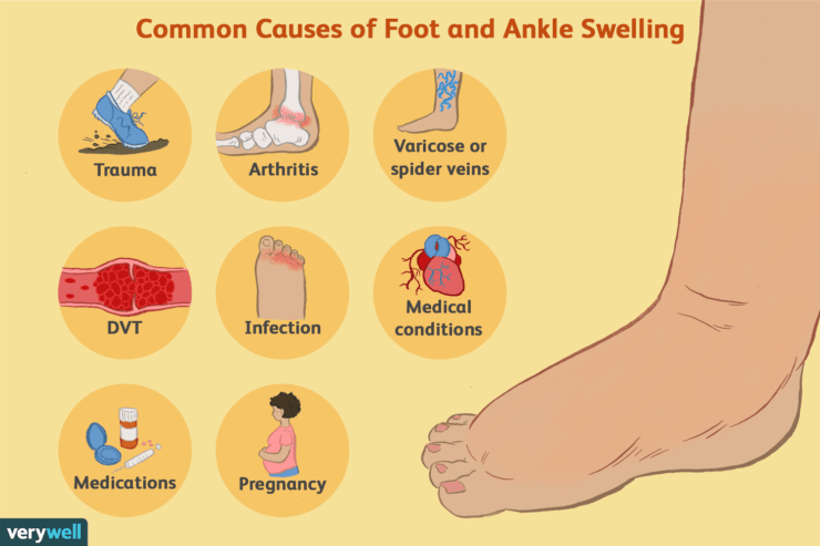 the-medicine-cabinet-ask-the-harvard-experts-why-ankle-swelling-happens