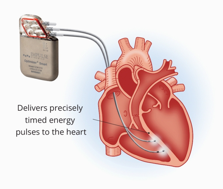 Cardiac Contractility Modulation The Latest In Device Technology Gregory Koshkarian MD FACC